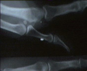 XRay of Alien implant